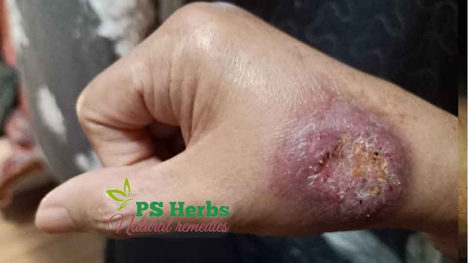 Penyakit Sporotrichosis Bahaya Rawat Sebelum Terlambat Ps Herbs